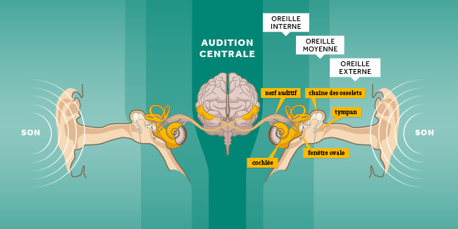Syndrome du choc acoustique oreille infographique